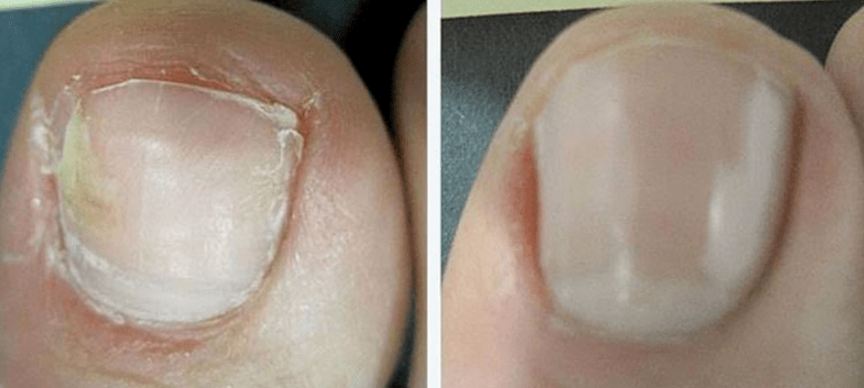 Toenail onddoa tratatu aurretik eta ondoren